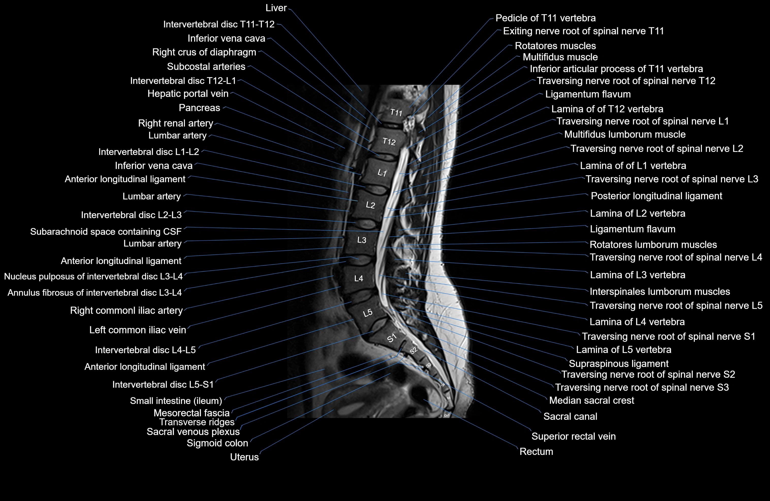 MRI lumbar spine sagittal cross sectional anatomy 3T radiology  image-img-00001-00011.webp